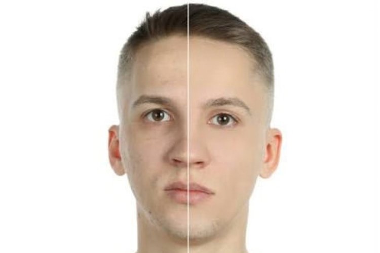 Chemical Peel treatment