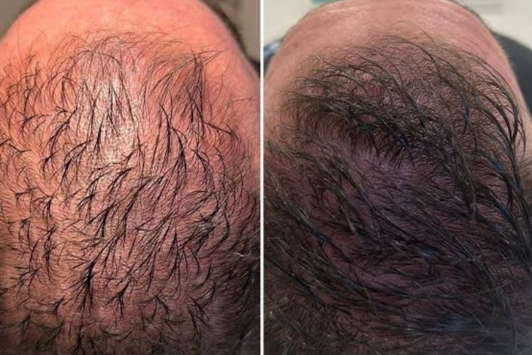Hair Loss Treatments at Shri Aesthetics