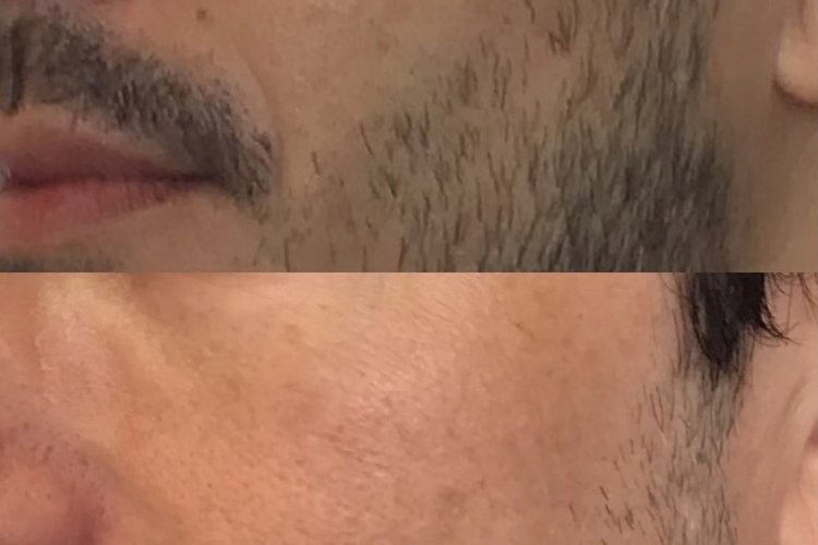 Pigmentation Treatment at Shri Aesthetics